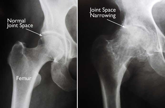 The x-ray on the left shows a normal hip joint with cartilidge.  On the right is a narrowed joint that needs to be replaced.