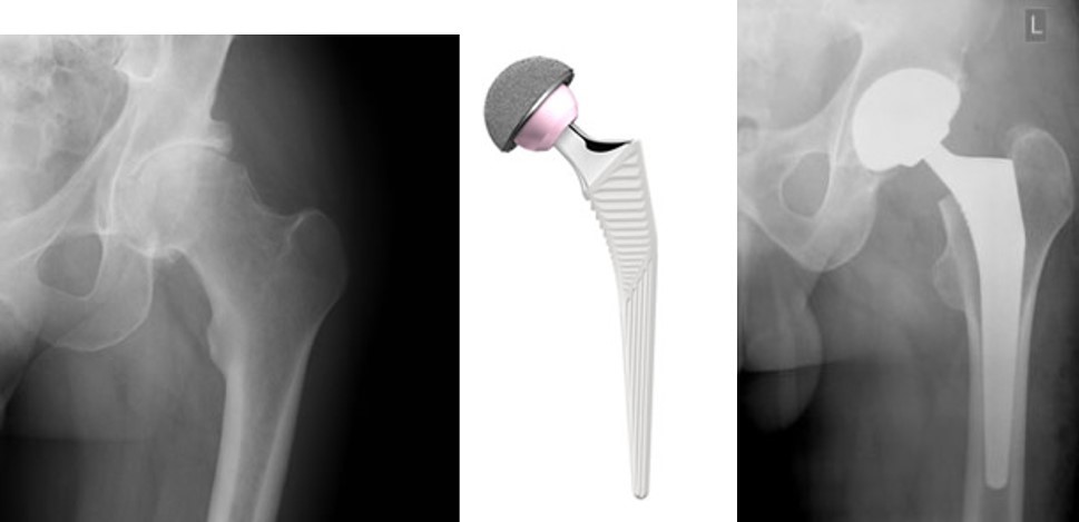 Left hand x-ray shows a hip in need of replacement.  In the middle is a drawing of a ball and socket prosthetic joint. On the right hand side is an x-ray showing the replacement hip joint in place.